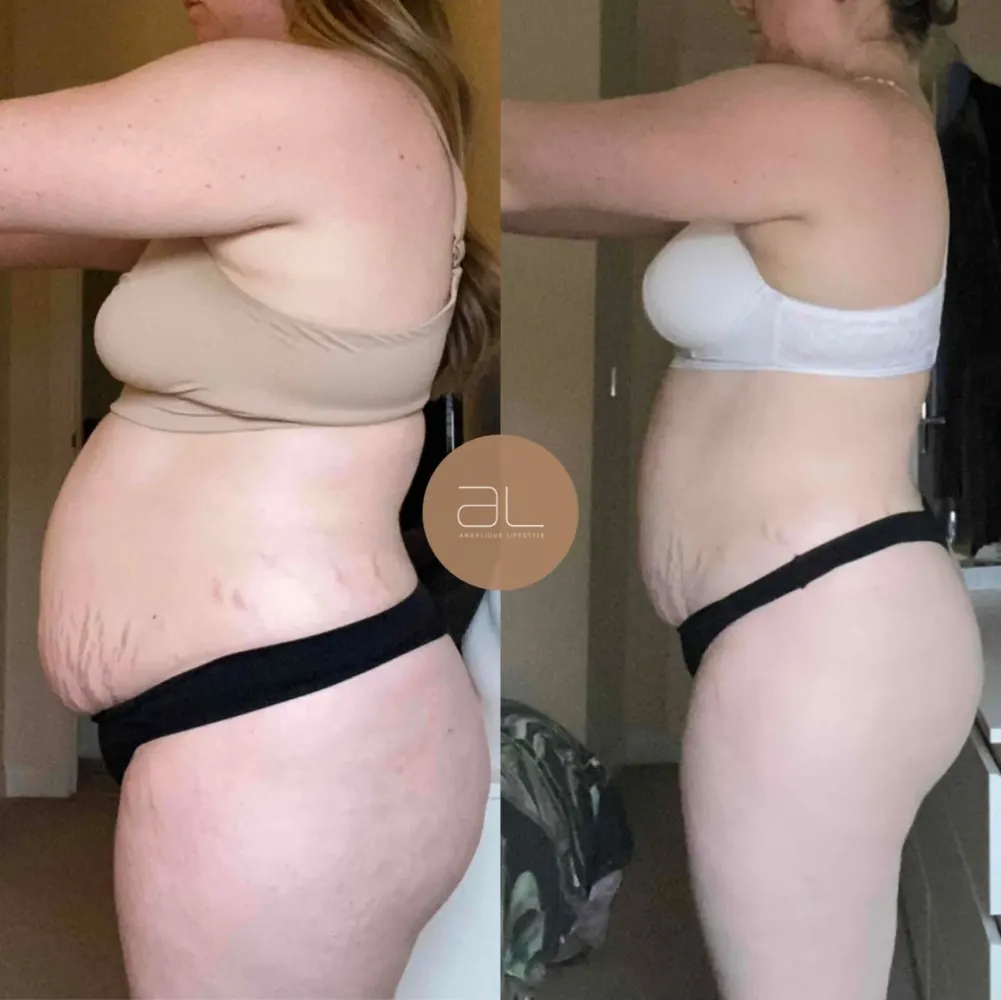 Client before and after, side view of her waist