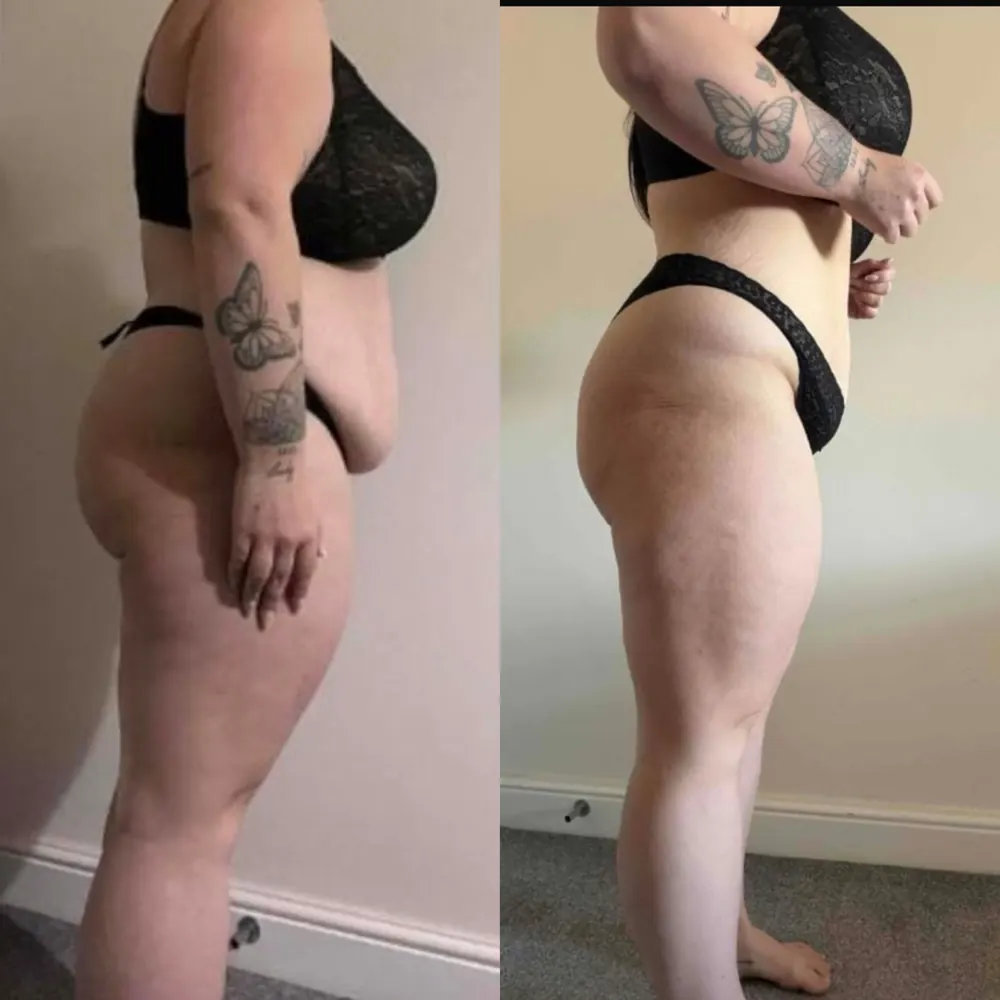 Client before and after, side profile